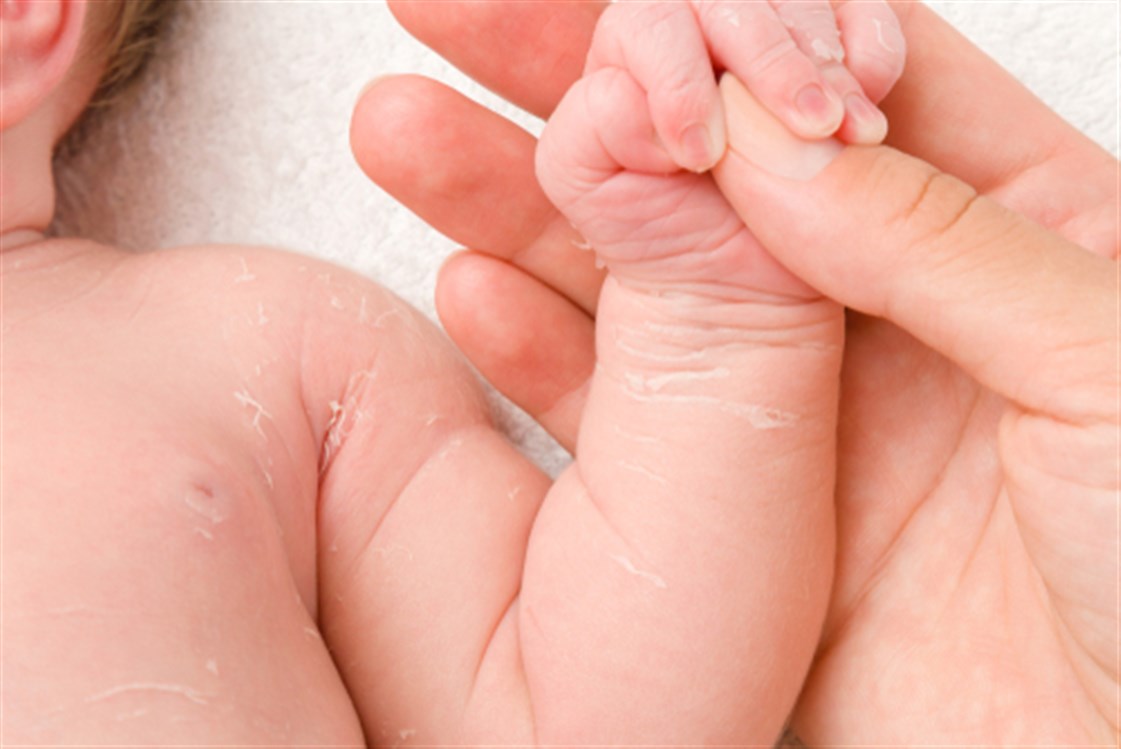 Сухая кожа рук у новорожденного